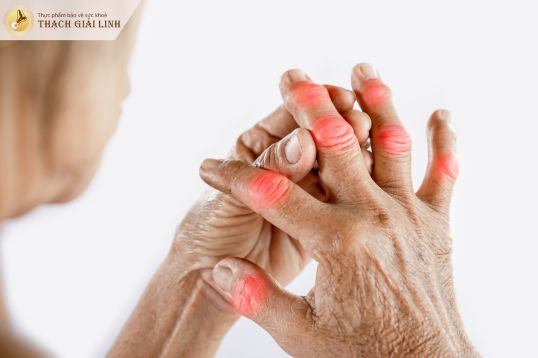 Cơn gout xuất hiện với tần suất ngày càng dày đặc bạn nên thăm khám ngay