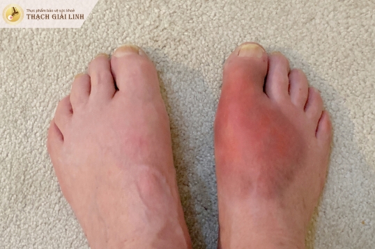 Sưng tấy nghiêm trọng vùng bị gout