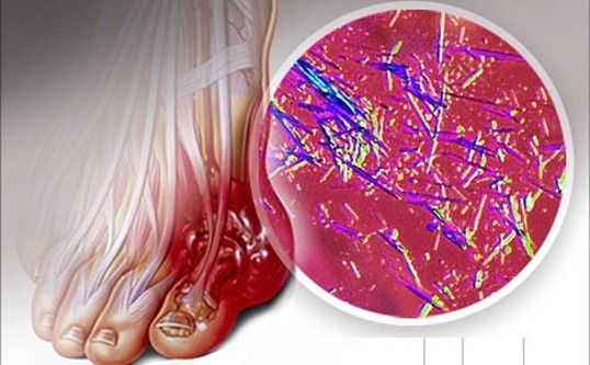 Acid uric là sản phẩm cuối cùng của quá trình chuyển hóa purin