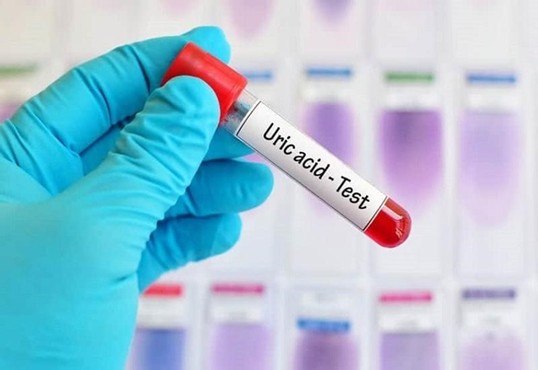 Xét nghiệm nồng độ acid uric trong máu