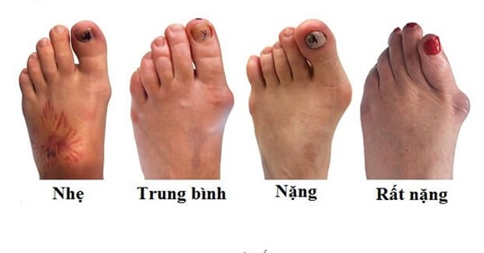 Mô phỏng triệu chứng bệnh gout qua các mức độ