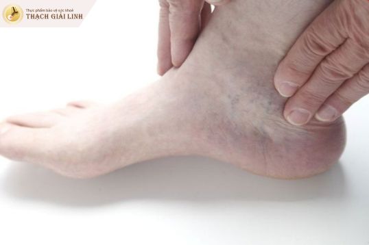 Đau mu bàn chân có thể do thoái hóa khớp