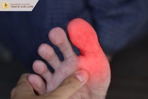 Đau ngón chân cái có phải bị gout?