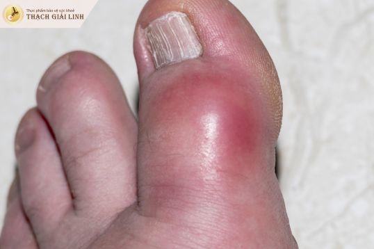 Ngón cái sưng, nóng, đỏ vùng khớp là dấu hiệu bị gout nặng