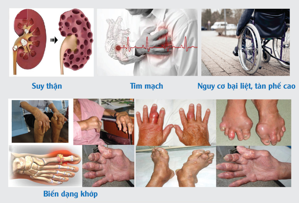 Công dụng vượt trội của Viên Gout Cấp Thạch Giải Linh