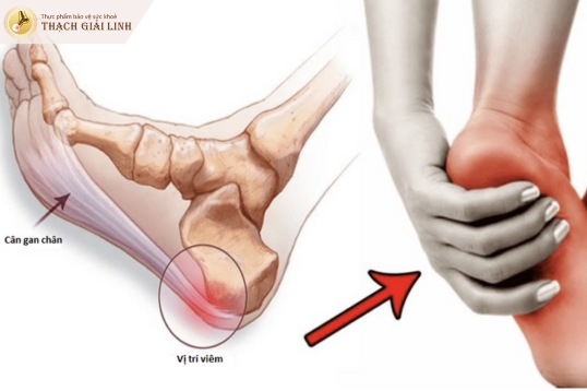 Mô phỏng viêm cân gan chân