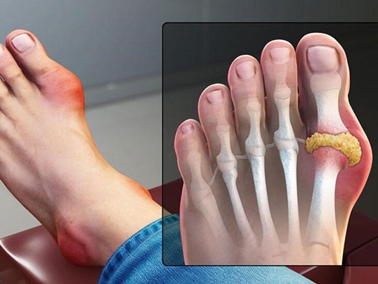 Hiểu đúng bệnh gout là gì