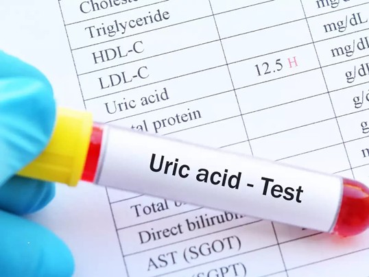 Viên gout cấp Thạch Giải Linh giúp ổn định nồng độ acid uric