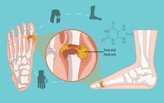 Acid uric tích tụ trong máu là nguyên nhân gây nên bệnh gout