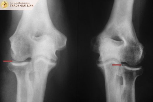 Chụp X-quang giúp phát hiện sớm sự lắng đọng tinh thể trong sụn khớp