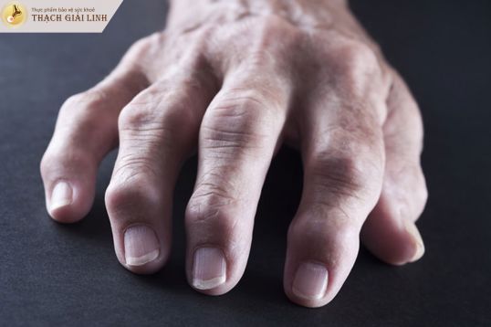 Bệnh giả gout khác gì với gout thông thường?