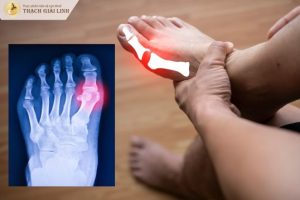 Bệnh gout là gì? Nguyên nhân, triệu chứng và cách điều trị hiệu quả