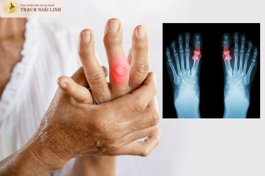 Bệnh gout là gì?