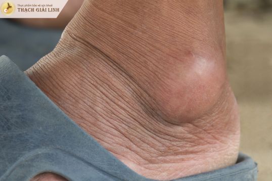 Gout mạn tính và tổn thương khớp vĩnh viễn