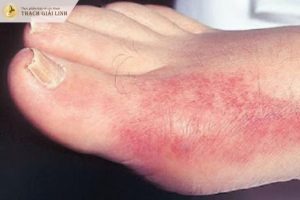 Biểu hiện của bệnh gút ban đỏ và những điều cần biết