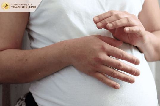 Thay đổi nội tiết sau sinh khiến bệnh gút ban đỏ dễ khởi phát
