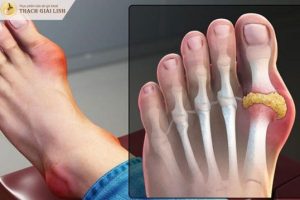 Dấu hiệu bệnh gout – Nhận biết sớm để kiểm soát hiệu quả