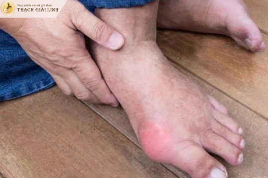 Khớp sưng đỏ, nóng và đau nhức là dấu hiệu bệnh gout