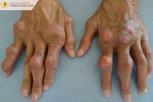 Xuất hiện hạt tophi là dấu hiệu gout ở giai đoạn mãn tính