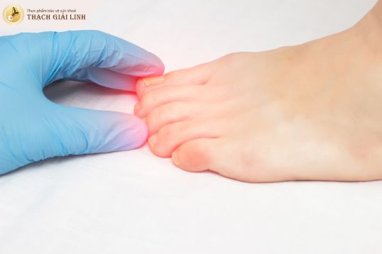 Dấu hiệu bệnh gout ở ngón chân - Khi nào cần đi khám ngay?