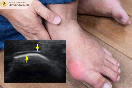 Hình ảnh dấu hiệu đường đôi trong gout
