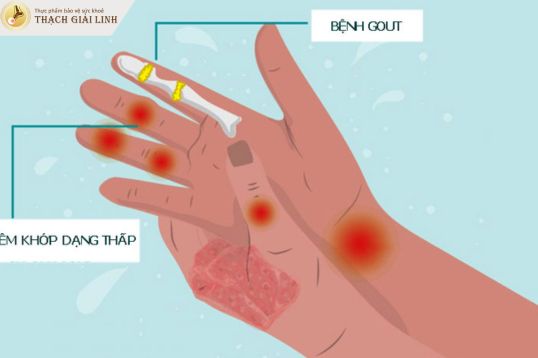Dấu hiệu đường đôi giúp phân biệt gout với các bệnh viêm khớp