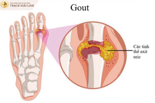 Thân nhiệt giảm vào ban đêm tăng sự kết tinh tinh thể urat tại khớp