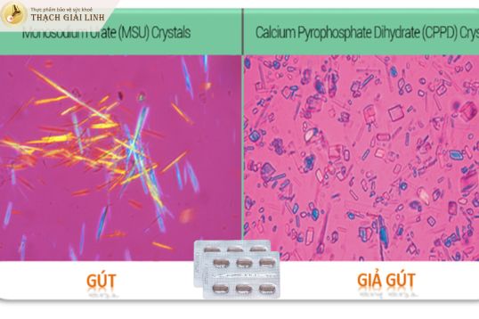 Chẩn đoán giả gout chính xác bằng xét nghiệm dịch khớp