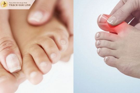 Đau ở những vị trí “lạ” như ngón chân cái