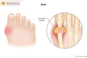 Triệu chứng lâm sàng của bệnh gout và cách nhận biết chính xác