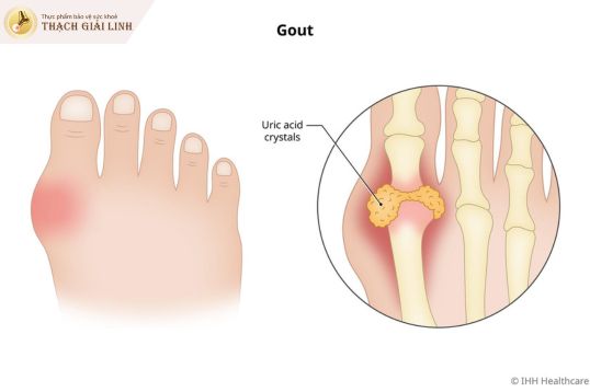 Triệu chứng lâm sàng của bệnh gout và cách nhận biết chính xác