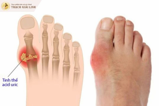 Bệnh gout là gì?