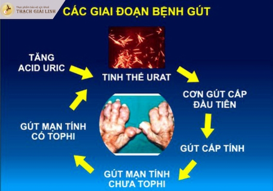 Giai đoạn tăng acid uric máu là giai đoạn đầu