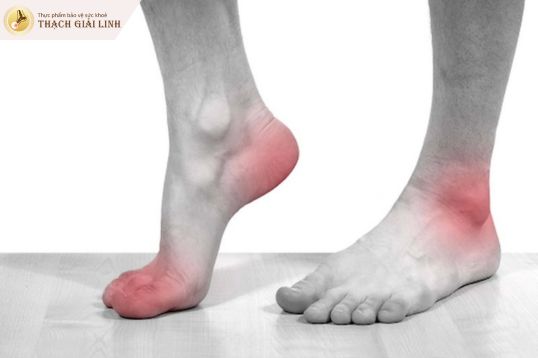 Cơn gout cấp điển hình thường sưng nóng đỏ