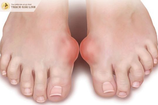 Bệnh gout mạn tính có thể xuất hiện hạt tophi