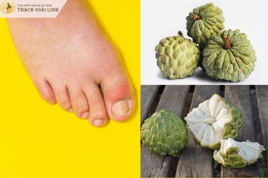 Bệnh gút có ăn được quả na không?