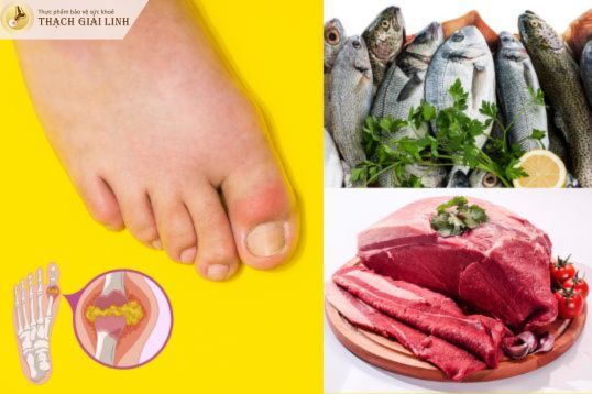 Bệnh nhân gout cần rất chú ý tới chế độ ăn uống