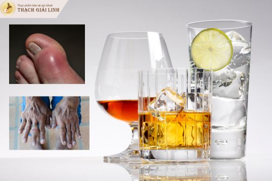 Tại sao người bệnh gout không nên uống rượu bia?