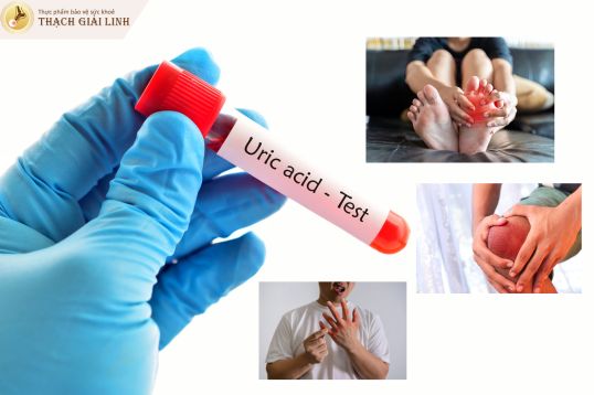 Rượu bia làm tăng sản sinh axit uric trong cơ thể